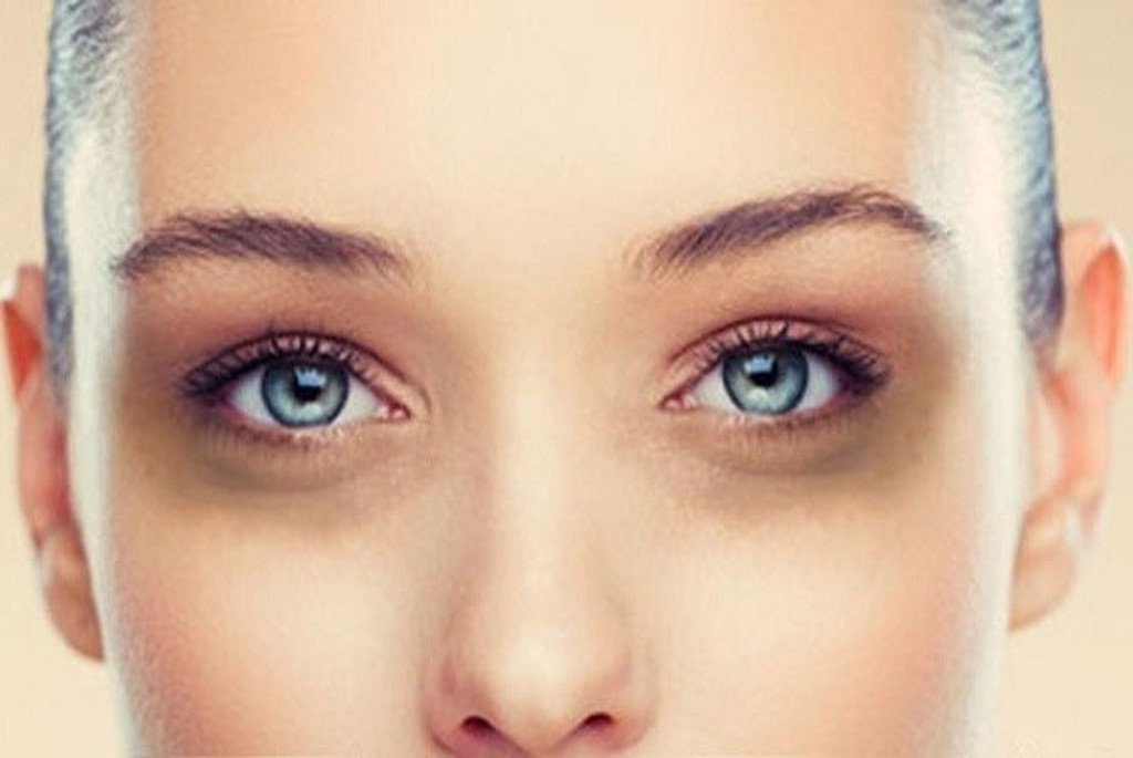 Sáu điều bạn cần biết về tình trạng thâm quầng mắt